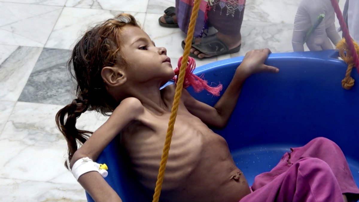 Saudi War on Yemen: World’s Worst Famine in a Century Could Claim 13 Million