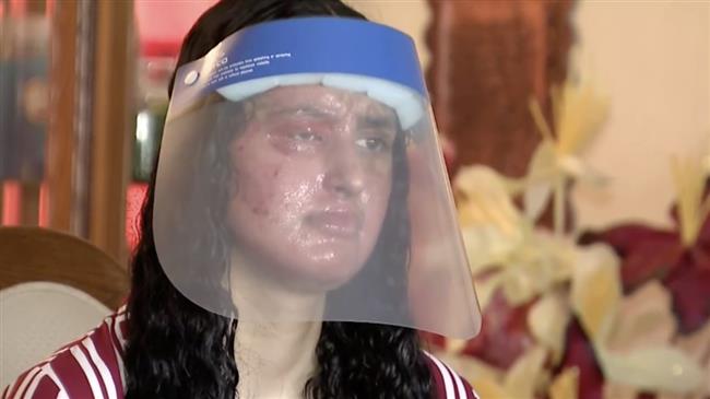muslim-woman-burned-in-acid-attack-in-new-york-in-another-hate-crime
